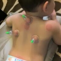 Çocuklar İçin Hacamat Kupaları